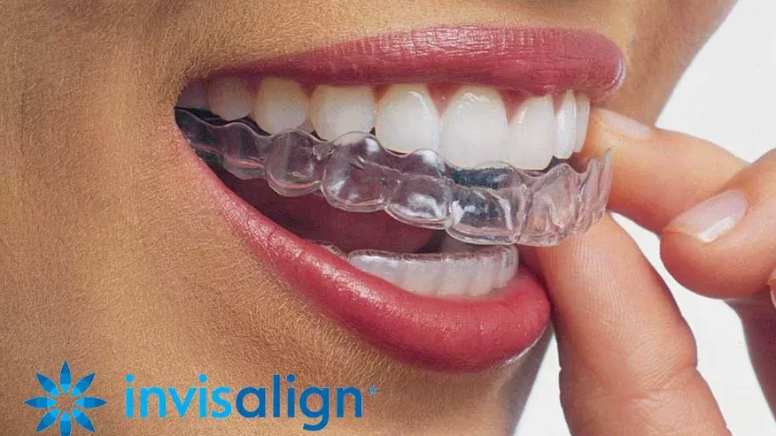 invisalign